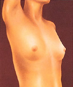 Breast augmentation is usually done to balance a difference in breast size, to improve body contour, or as a reconstructive technique following surgery.