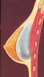 The breast implant may be inserted directly under breast tissue.
