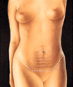 An incision just above the pubic area is used to remove excess skin and fat from the middle and lower abdomen.
