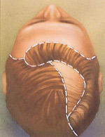 When the skin beneath the hair has stretched enough, it is surgically placed over the bald area.