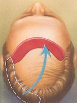 During flap surgery, a section of bald scalp is cut out and a flap of hairbearing skin is sewn into its place.