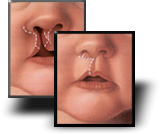 A procedure to correct cleft of the lip and or the palate in children born with this anomaly.