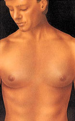Many men have gynecomastia -- enlarged, female-like breasts--causes by excess glandular tissue or fat (or both).